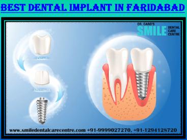 Best Dental Implant Clinic in Faridabad Treatment by Dr. Garg