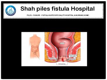 What Is Fistulotomy?