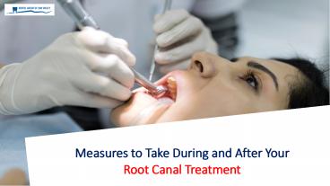 Measures to Take During and After your Root Canal Treatment