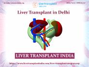 Find The Best Liver Transplant in Delhi