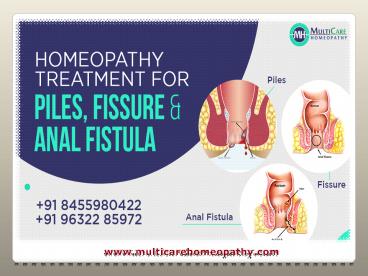 Best Homeopathy Treatment for Piles, Fissure & Anal fistula - Multicarehomeopathy