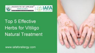 Top 5 Effective Herbs for Vitiligo Natural Treatment