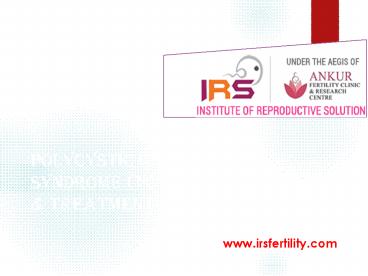 Polycystic Ovarian Syndrome (PCOS) Symptoms & Treatment