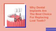 Dental Implants The Best Choice For Tooth Replacement