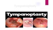Tympanoplasty