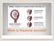 What is Placenta Accreta? | Specialty Care Clinics