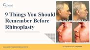 9 Things You Should Remember Before Rhinoplasty