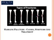 Hairline Fracture - Causes, Symptoms and Treatment