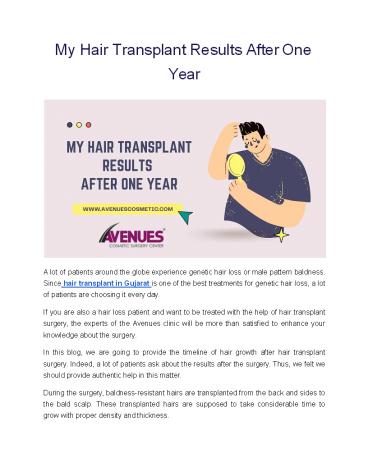 My Hair Transplant Results After One Year