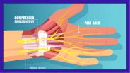 Carpal Tunnel Syndrome