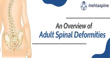 An Overview of Adult Spinal Deformities | Mehta Spine