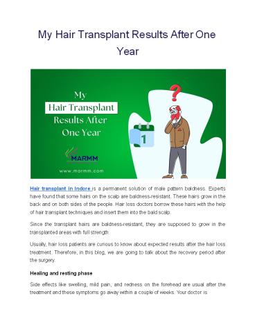 My Hair Transplant Results After One Year