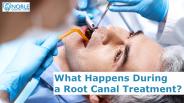 What Happens During a Root Canal Treatment?