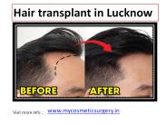 Hair transplant in Lucknow (1)
