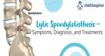 Lytic Spondylolisthesis Treatment and Diagnosis | Mehta Spine