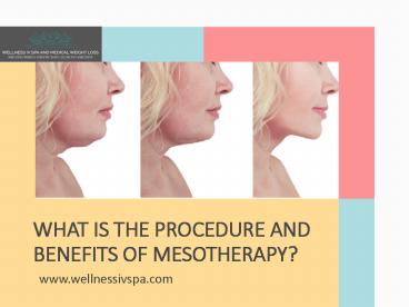 What is the Procedure and Benefits of Mesotherapy?