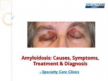 Amyloidosis: Causes, Symptoms, Treatment & Diagnosis