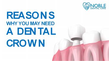 Reasons Why You May Need a Dental Crown