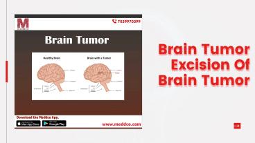 Brain Tumor Excision Of Brain Tumor