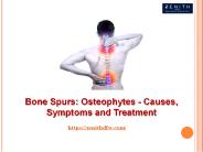 Bone Spurs: Osteophytes - Causes, Symptoms and Treatment