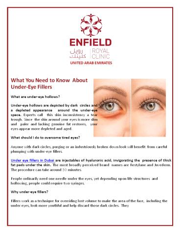 What You Need to Know About Under-Eye Fillers