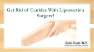 Get Rid of Cankles With Liposuction Surgery