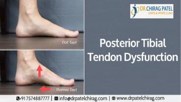 Posterior Tibial Tendon Dysfunction |Treating Fallen Arches