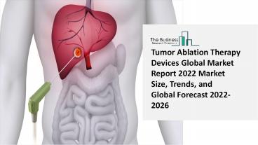 Global Tumor Ablation Therapy Devices Market Insights, Trends Sales, Supply, Demand 2022-2031