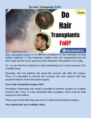 ​Do Hair Transplants Fail?