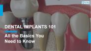 Dental Implant Procedure