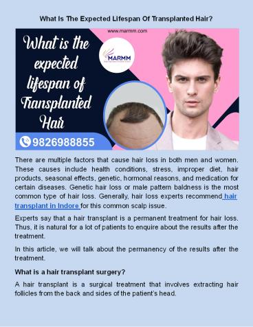 What Is The Expected Lifespan Of Transplanted Hair?