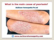 What is the main cause of psoriasis?