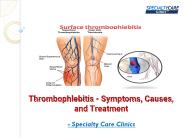 Thrombophlebitis - Symptoms, Causes, and Treatment