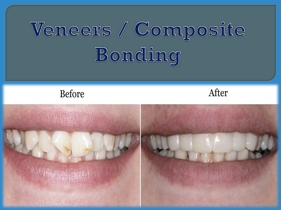 Veneers / Composite Bonding