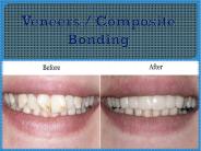 Veneers / Composite Bonding