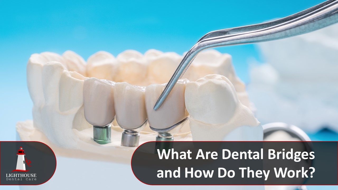 Dental Bridges: What Are They and How Do They Work?