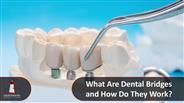 Dental Bridges: What Are They and How Do They Work?