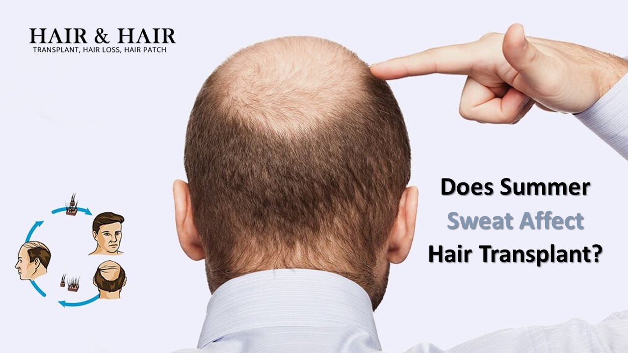 Does Summer Sweat Affect Hair Transplant?