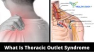 Stretching Exercises For Thoracic Outlet Syndrome Treatment