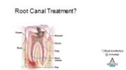 Root Canal Treatment?