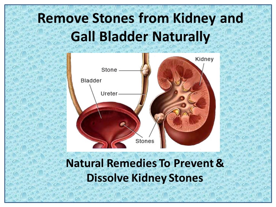 Kidney Stones Naturally with Stonil Capsule
