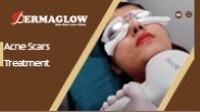 Acne Scars Treatment | Dermaglow Skin Clinic