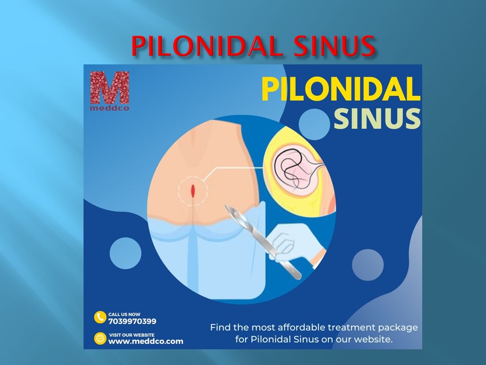 PPT Pilonidal Sinus PowerPoint presentation free to download id