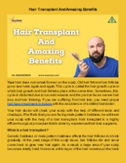 Hair Transplant And Amazing Benefits
