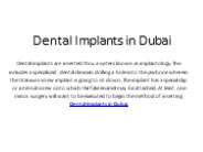 Dental Implant in Dubai