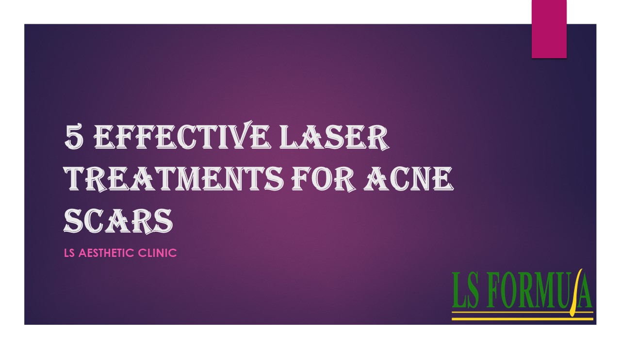 PPT 5 Effective Laser Treatments for Acne Scars PowerPoint
