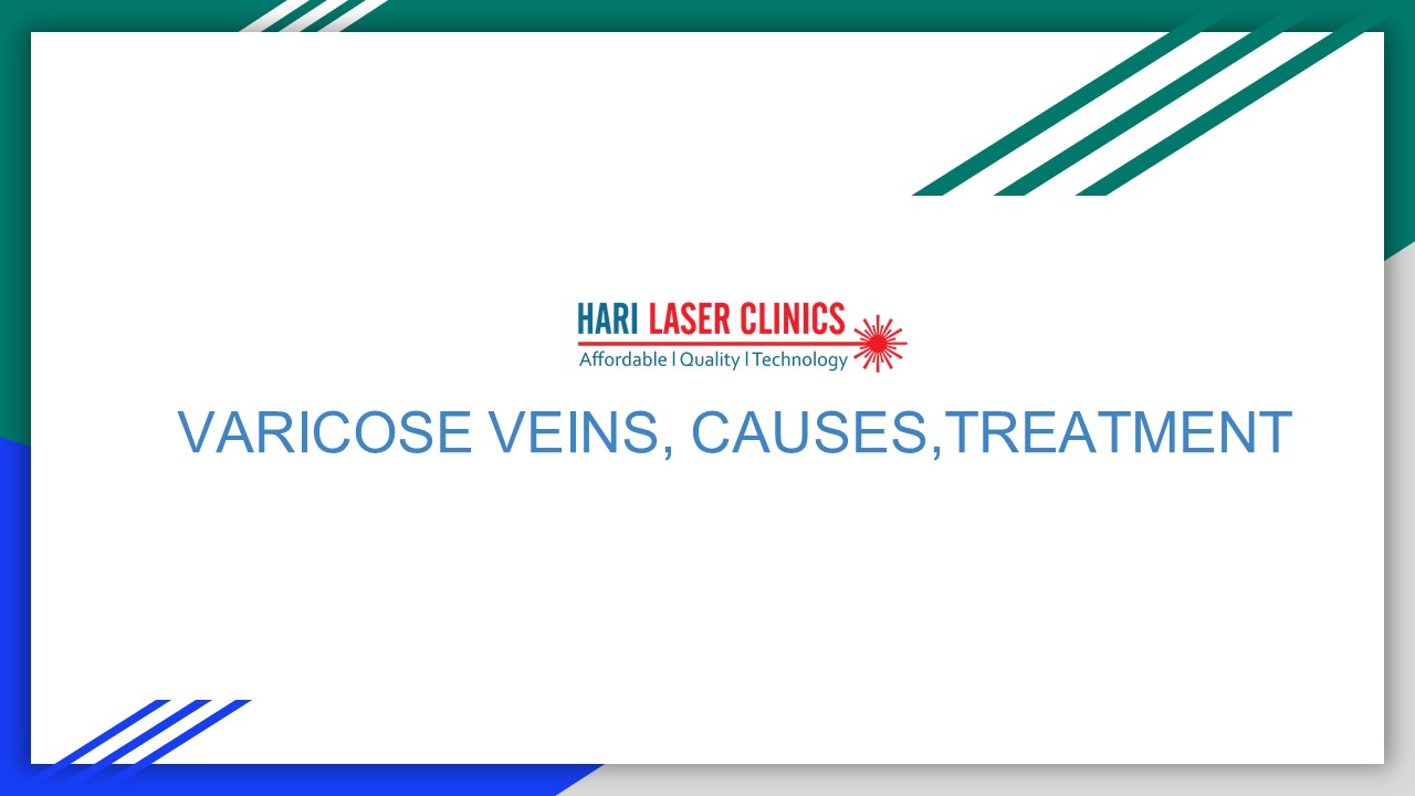 Varicose veins, causes, treatment