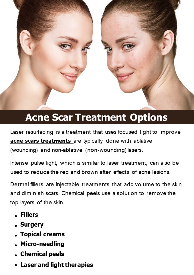 PPT Acne Scar Treatment Options PowerPoint presentation free to