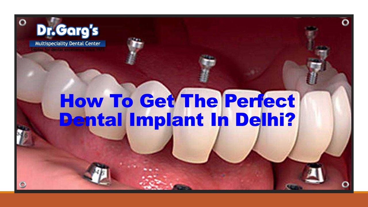 How To Get The Perfect Dental Implant In Delhi?