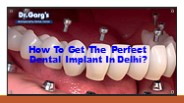 How To Get The Perfect Dental Implant In Delhi?